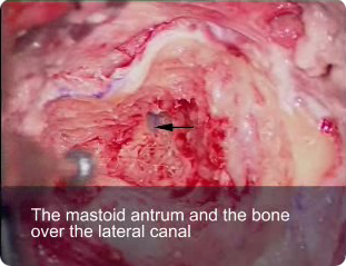 Cortical Mastoidectomy